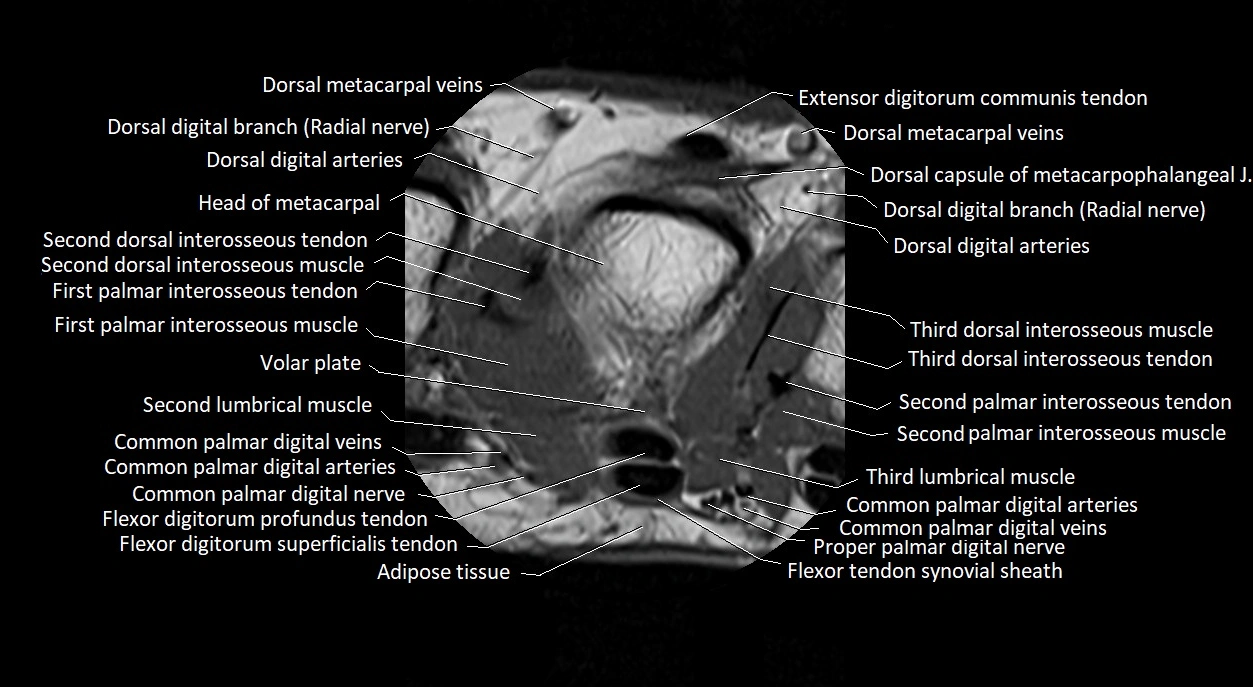Finger anatomy axial cross sectional 3T image image 26.webp